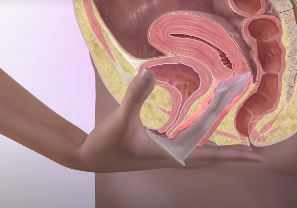 여성용콘돔 페미돔 사용방법