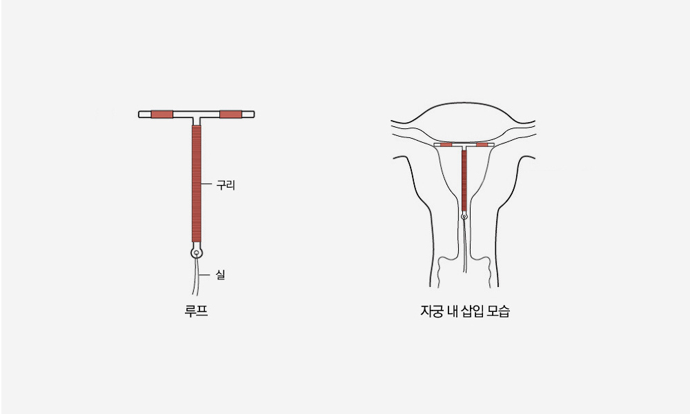 구리 루프의 형태와 자궁 내 삽입 시 모습