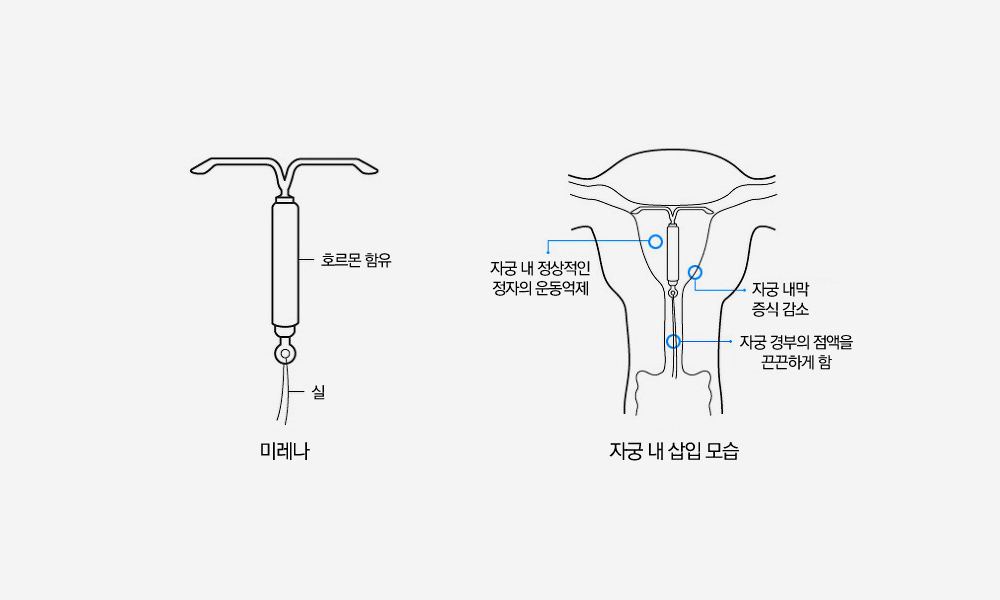 호르몬 루프 미레나의 형태와 자궁 내 삽입 모습